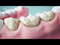 Https Www Prodente De Fileadmin Redakteure Videos Karies