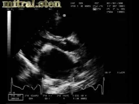 Mitral Stenosis In Different Aspects: Calcified Mitral Stenosis