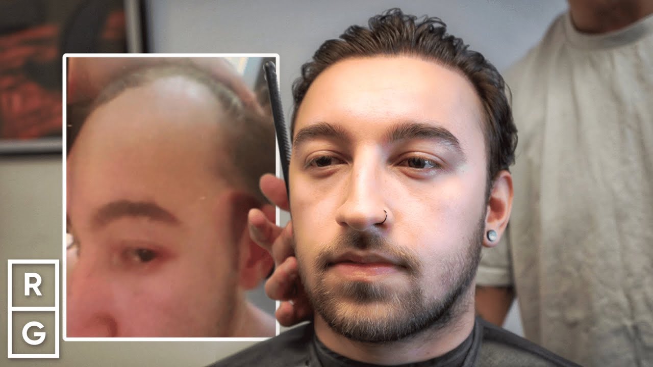 “I Got a Hair TRANSPLANT!" Taper Haircut After Hair Loss at 16 | Talking Hair Loss EP 11