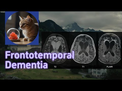 Frontotemporal Dementia vs Alzheimer Disease with Histology | UWorld USMLE MBBS