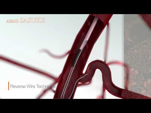 Reverse Wire Technique with ASAHI SASUKE Double Lumen Catheter