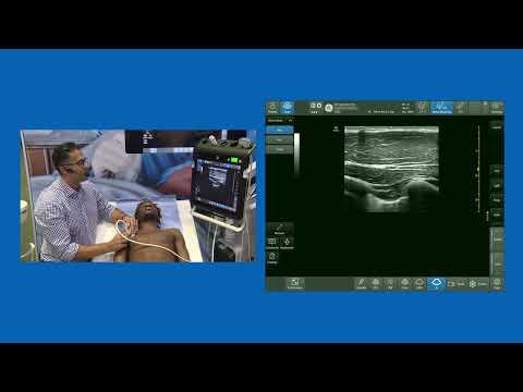 PECS 2 or PectoSerratus Plane Block