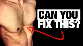 How to Fix a Sunken Chest! (PECTUS EXCAVATUM)