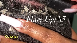 Flare Up: Part 3