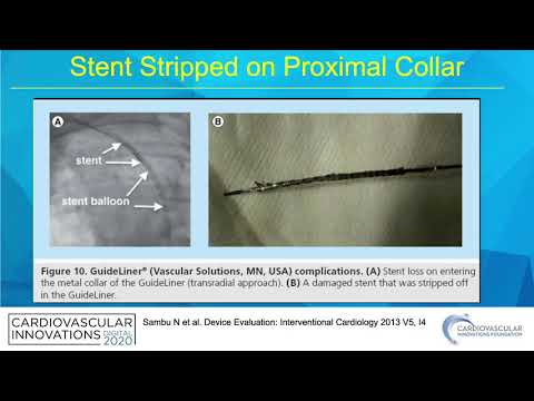 Guide extension complications - Thomas Tsai, MD