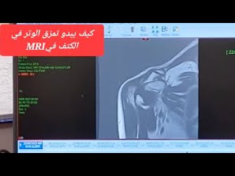 Rotator cuff tear on MRI torn shoulder tendon