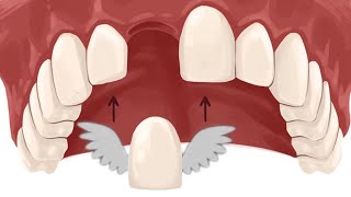 Resin Retained Bridges Simplified in 10 Short Minutes! | Ace Courses Webinar Summary