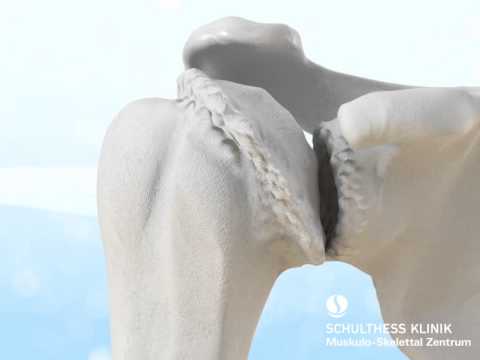 «Schulterarthrose - künstliches Schultergelenk» - Schulthess Klinik