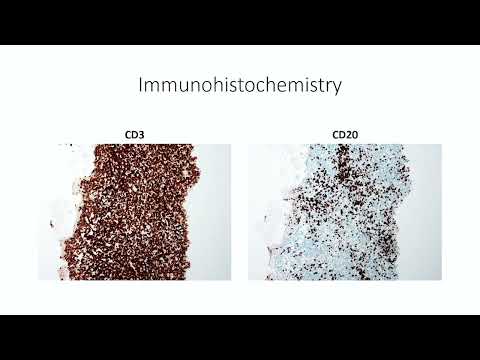Challenging cases (myeloma/lymphoma) – Dr. Reem AlRabeh (September 15-16, 2023)