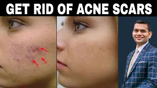How To Get Rid Of Acne Scars Completely