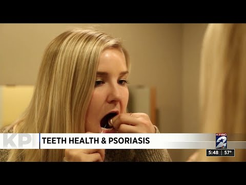 Teeth health and the connection to psoriasis