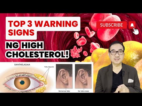 3 WARNING SIGNS NG HIGH CHOLESTEROL! | DR TONY LEACHON