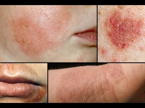 Streptocide ed eczema Cura di psoriasi a stregoni