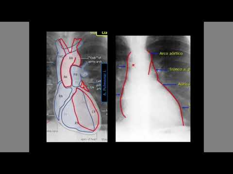 Articolazioni malattia metatarsofalangee Trattamento dellartrosi in atleti