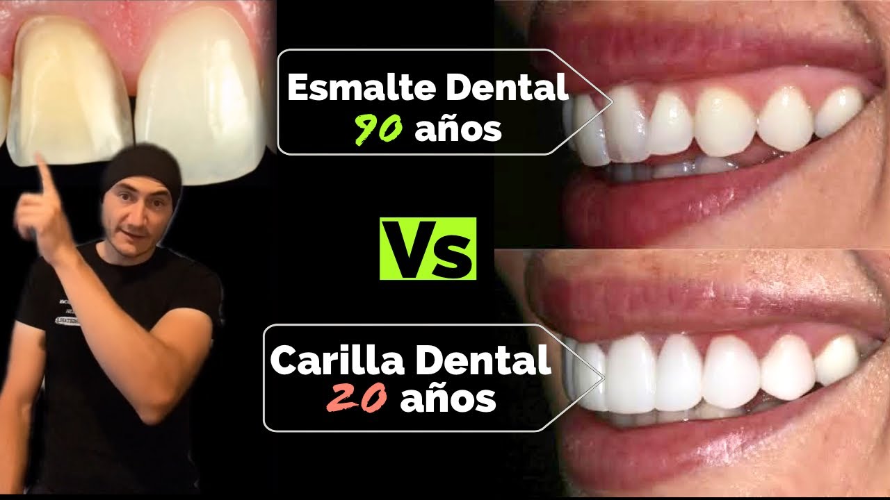 El esmalte dental dura 90 años, las carillas 20. ¿Les hace sentido