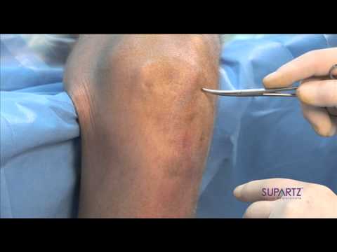 Flexed knee inferior lateral injection