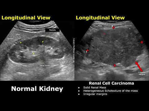 Kidney Ultrasound Normal Vs Renal Cell Carcinoma Image Appearances | Malignant Renal Cancers RCC USG