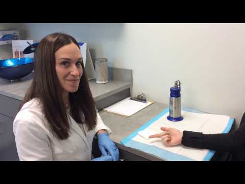 Wart Removal Using Liquid Nitrogen