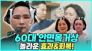 [성형 브이로그]60대 안면목거상 2주차 전후 이정도라고? - 정은님의 리얼스토리 1탄!