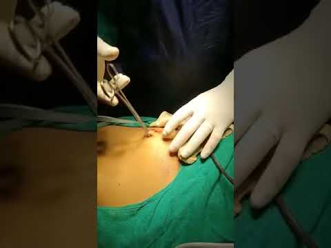 Pneumoperitoneum creation veeres method