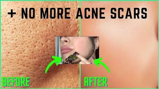 How To Get Rid Of ACNE SCARS + LARGE PORES PERMANENTLY [100% Works] All Natural Glass Skin DIY