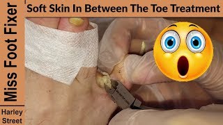 Soft Skin in between the Toe | callus in the foot | ID Corns Miss Foot Fixer Marion Yau