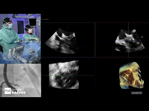 Advancing structural heart with 3D ICE and device guidance - PCR London Valves 2025