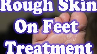 Rough Skin On Feet | Best Remedies To Get Rid Of Rough Skin On Feet