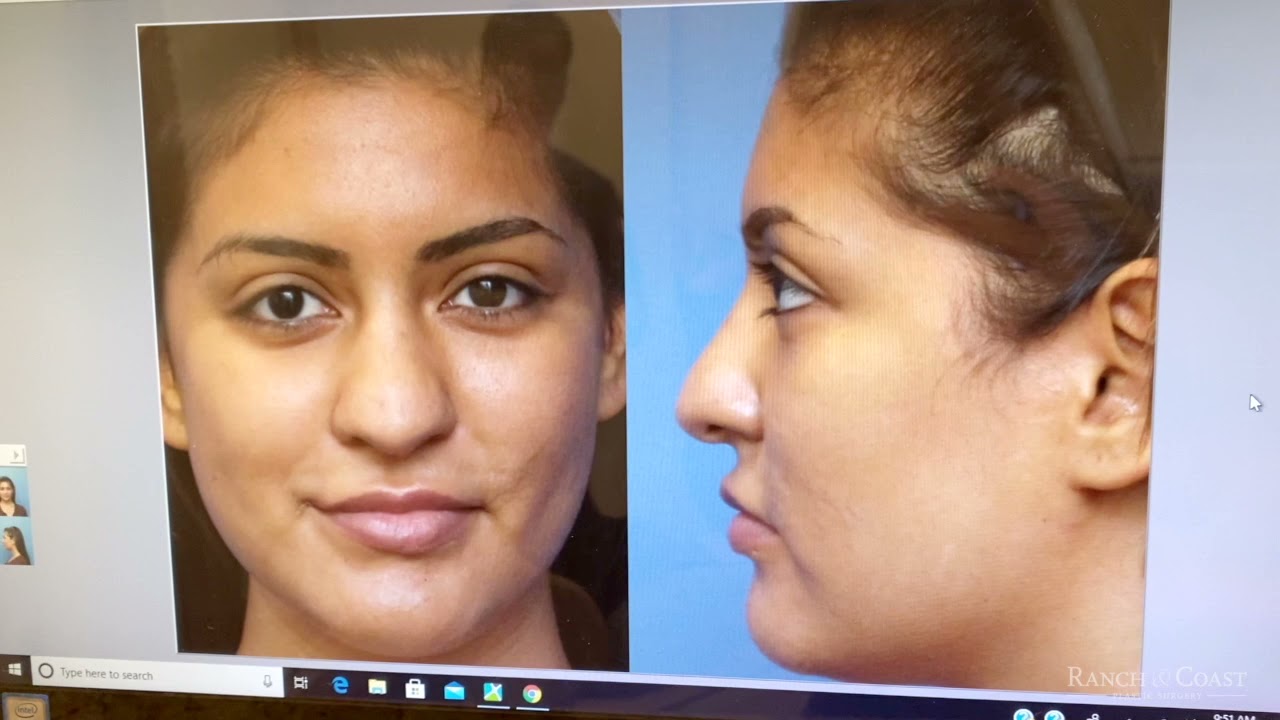 Rhinoplasty Reveal - #11