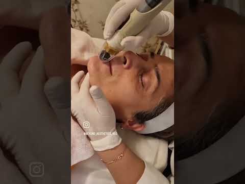 DERMAFRAC treatment | Beyond Aesthetics