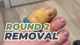 Ingrown Removal | Round 2!