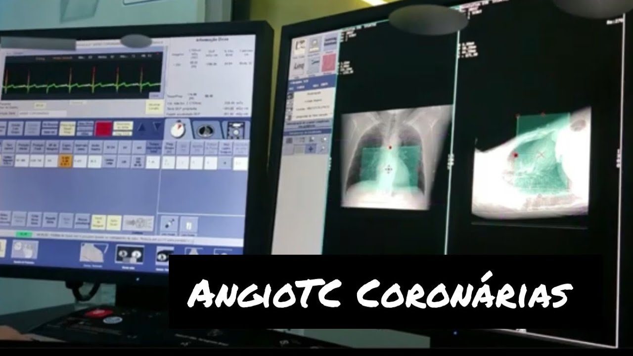 ANGIOTC ART. CORONÁRIAS - NA PRÁTICA