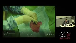 Live Case of Right Heart Catheterisation using Dynamic Exercise – Dr Katrina Adorini