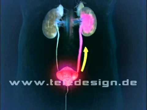 Komplikationen der Prostata-Operation CT Anzeichen von Prostata-Hyperplasie
