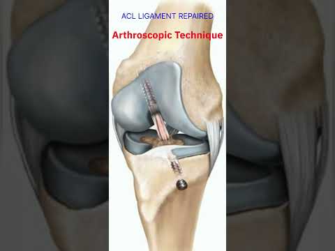 Anterior cruciate ligament tear repaired done Arthroscopic technique| Dr. Deepak Koli