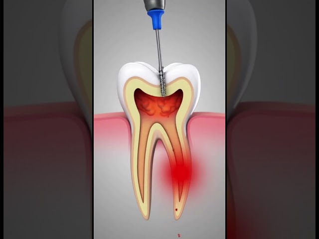 Root Canal Treatment Explained in 3D