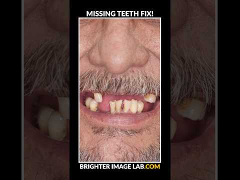 Missing Teeth Solution - Snap On Veneers #shorts #smiletransformation