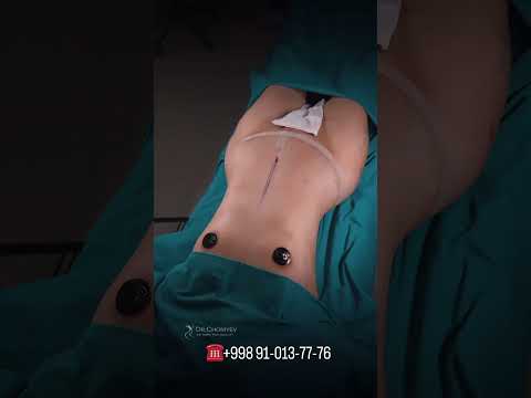 Body Lifting — Dr. Choriyev #2