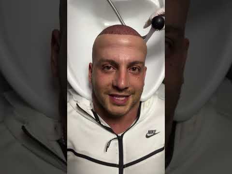 5250 Grafts Hair Transplant