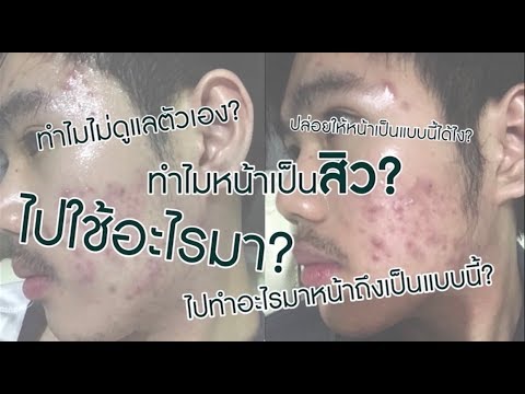 โรคสะเก็ดเงินบนข้อศอกของเด็ก Silymarin ในโรคสะเก็ดเงิน