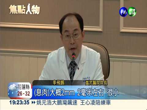 總統健康檢查 大腸發現2息肉