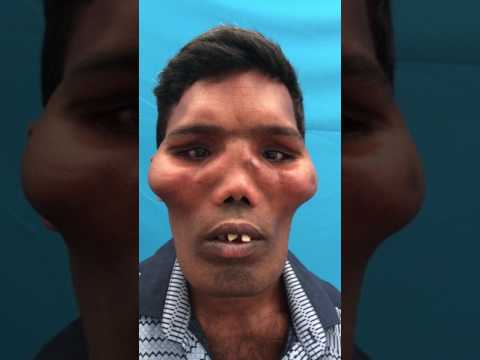 Leontiasis Osea - (Lion Faces) Marble Bone Disease