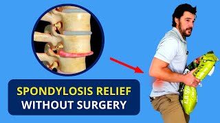 Download lagu Spondylosis Treatment Without Surgery 🔥 Spondylolisthesis Causes mp3 Download lagu Spondylosis Treatment Without Surgery 🔥 Spondylolisthesis Causes mp3