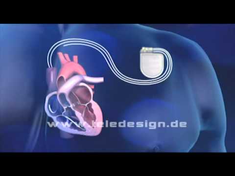 HGL 017 Schrittmacher biventrikulär  - PAL 16:9/ HGL 017 Pacemaker    - PAL 16:9