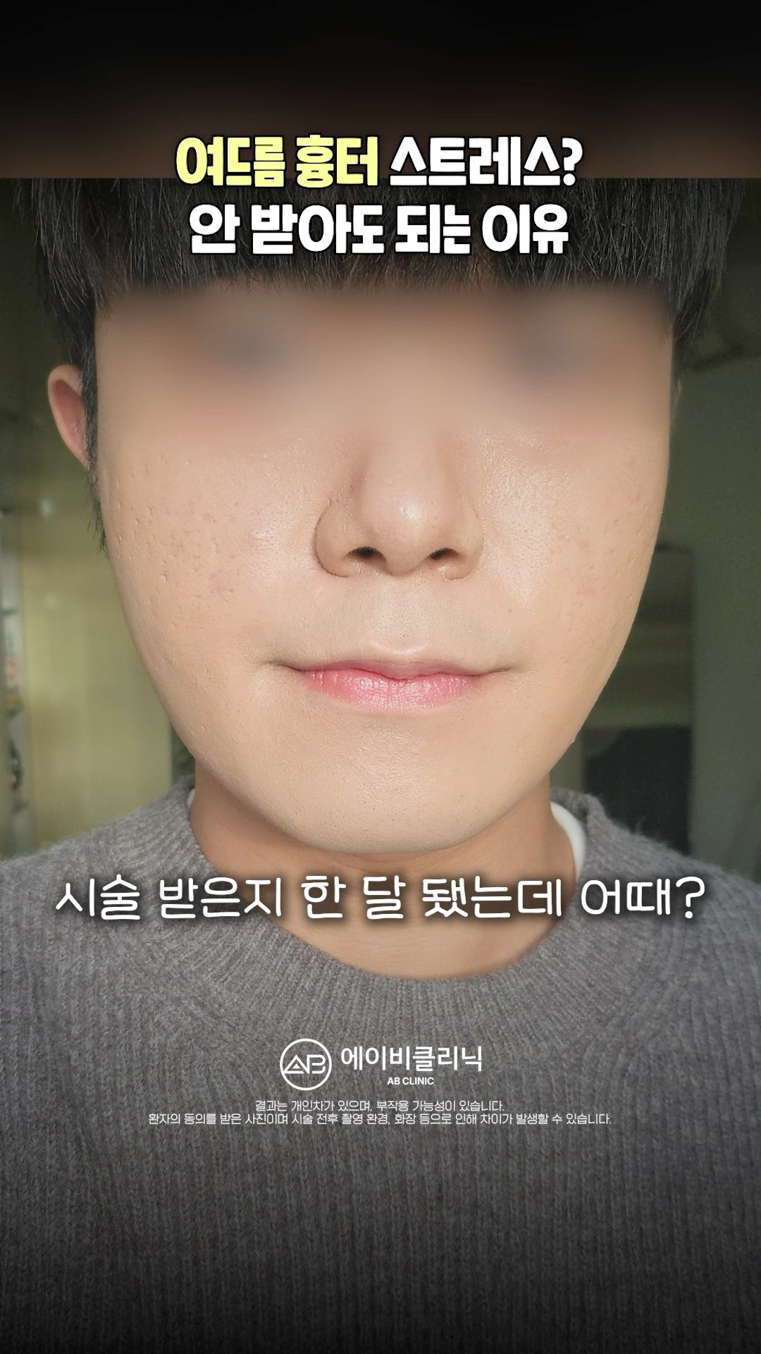 두껍게 가렸던 여드름 흉터, 이것만 받아보세요❗