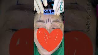 이마 리프트 성형 시술