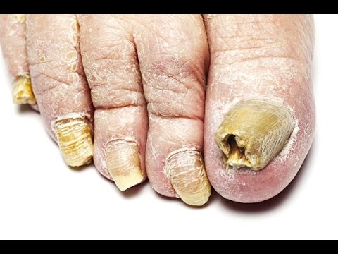 Iwanowo die Behandlung der Nägel Die Behandlung gribka der Nägel mikosseptin