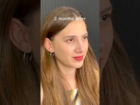 Life changing rhinoplasty