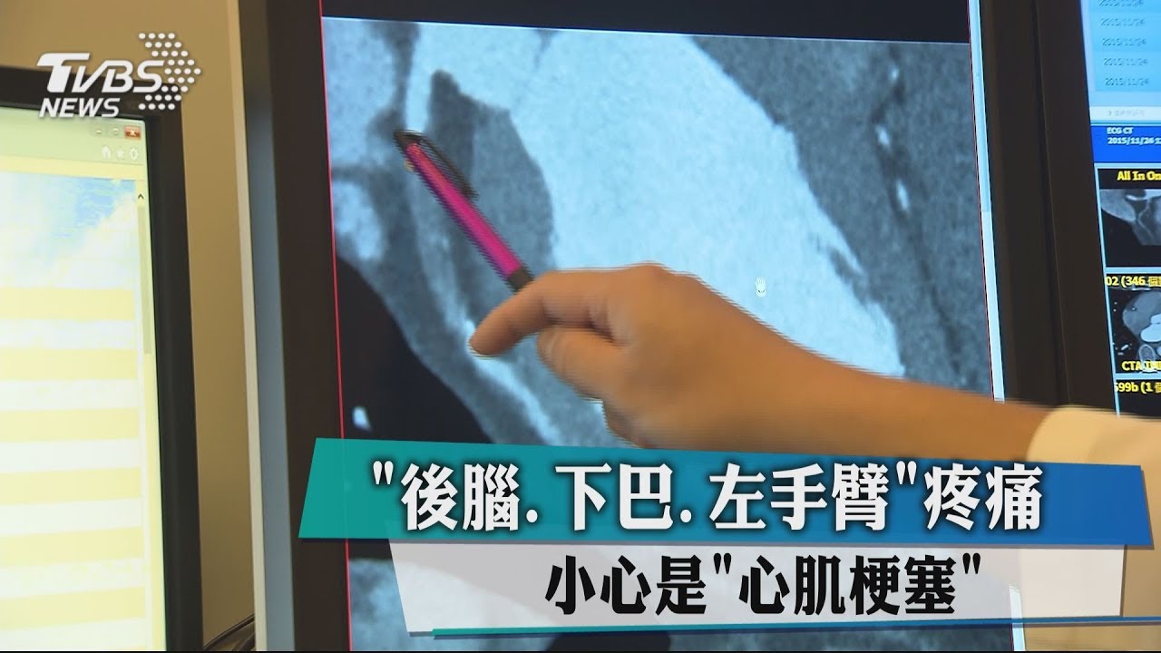 「後腦、下巴、左手臂」疼痛 小心是「心肌梗塞」前兆