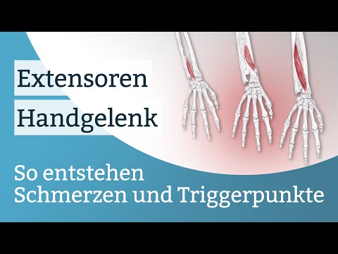 Extensoren Schmerzen, Triggerpunkte und deren Aktivierung